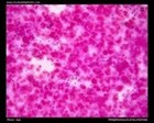 S.pneumoniae in CSF